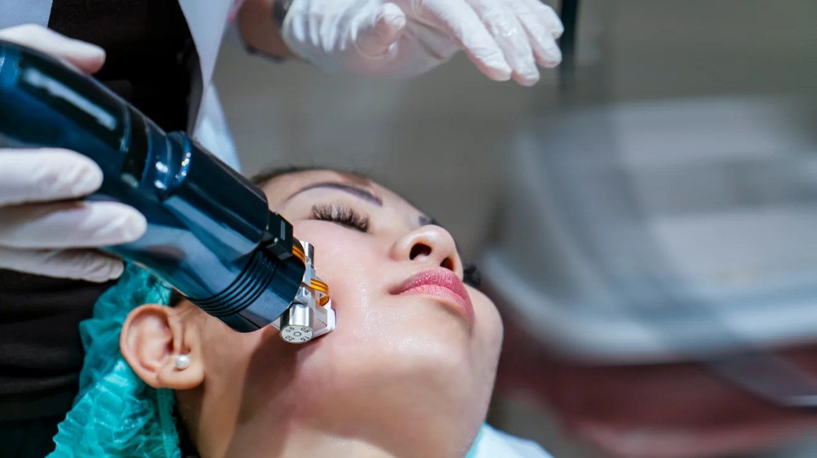 RF Microneedling treatment